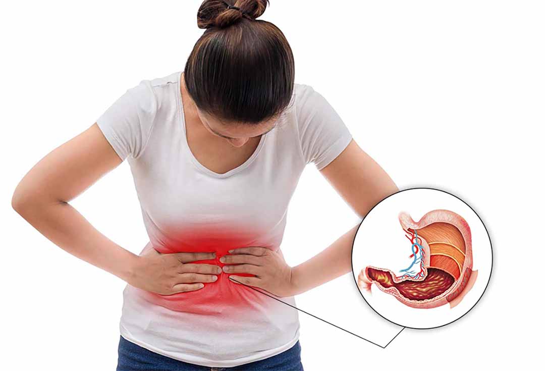 Polyp dạ dày có nguy cơ ung thư không?- Ảnh 2.